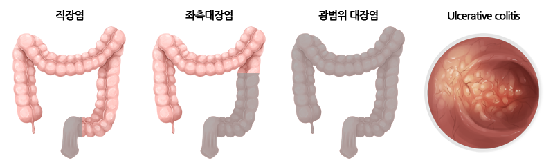 직장염, 좌측대장염, 광범위 대장염, 궤양성 대장염